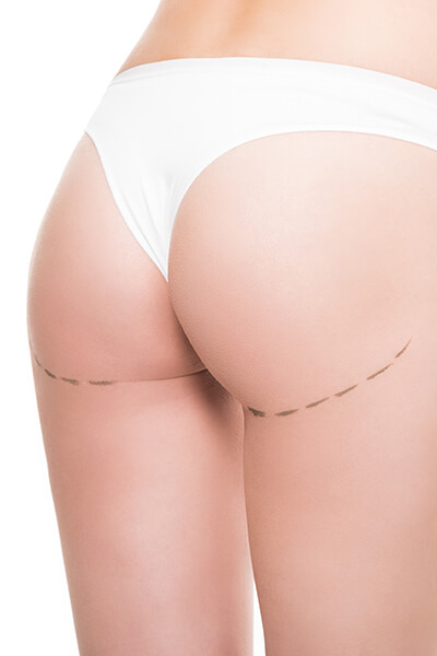 Gluteoplastia con implantes Clinica Leblanc
