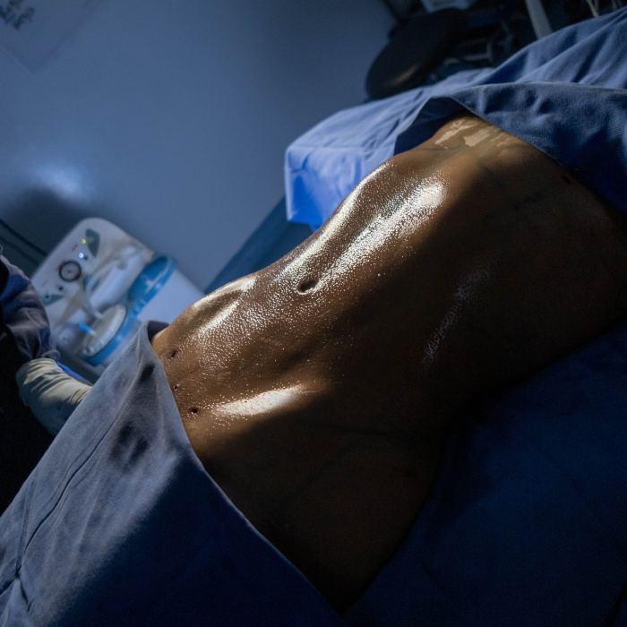 Lipoescultura Clinica Leblanc Cucuta Colombia